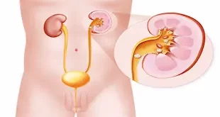 What are the clear symptoms of kidney stones?